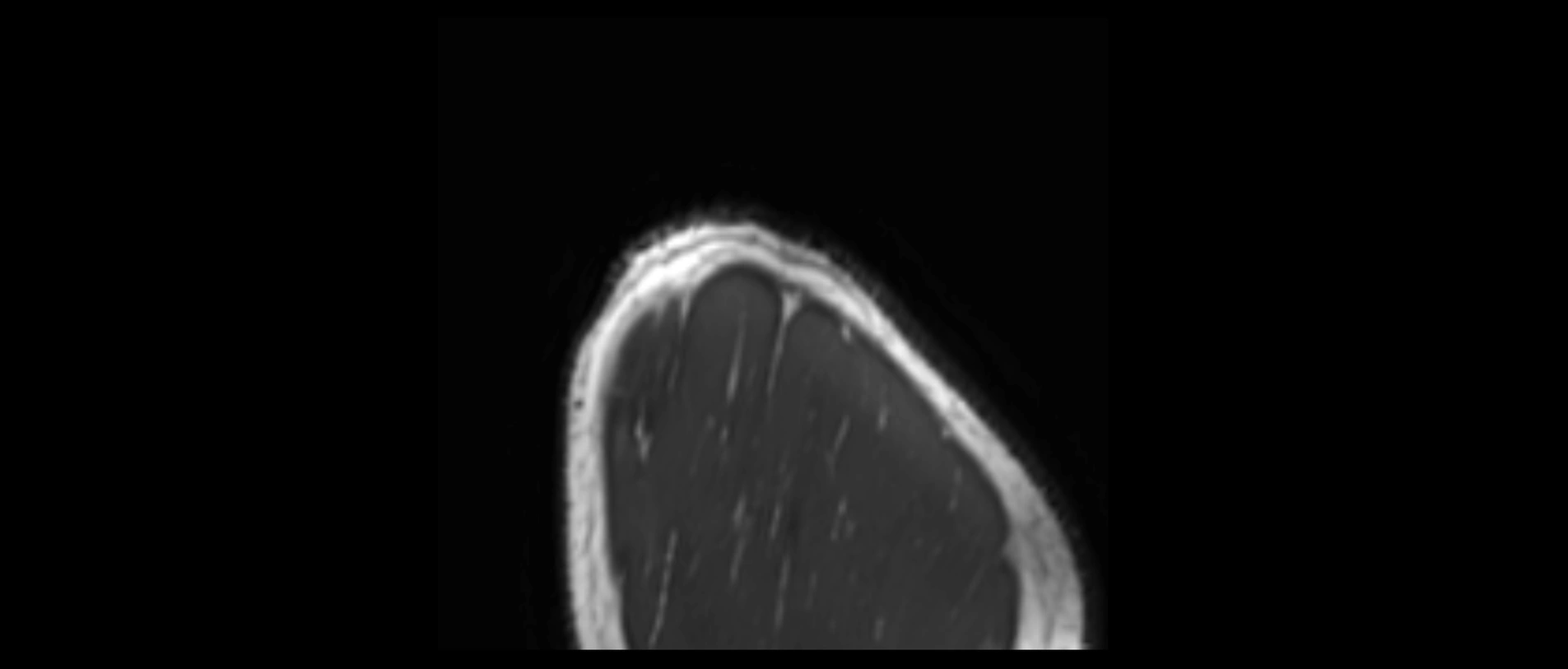 shoulder ligaments sagittal  cross sectional anatomy 3T MRI AI enhanced radiology image -img-00001-00061.webp